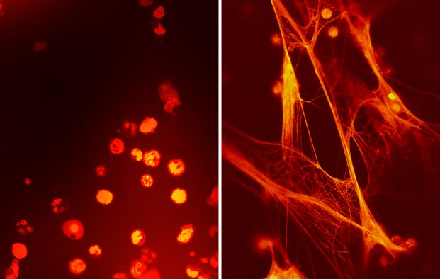 Anti-inflammatory Agent Isolated From Umbilical Cord Blood Infection fighting cells from umbilical cord blood (left) and circulating blood three days after birth (right) from the same prematurely born baby. Umbilical cord blood has high levels of a factor, called neonatal NET inhibitory factor (nNIF), which inhibits a specific inflammatory response called NETs. Within two weeks after birth, nNIF levels drop and NETs can form. True to their name, they consist of a net-like substance that traps infectious agents like bacteria, as seen on the right. nNIF is showing promise as a potential therapy against harmful inflammation and sepsis.